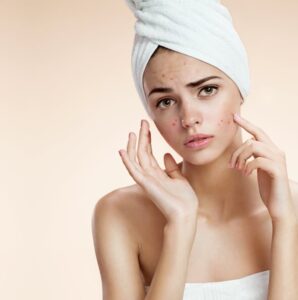 skin care tips for acne scars
